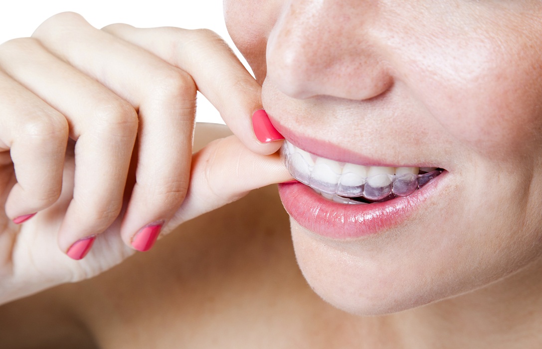 using rubber bands to straighten teeth