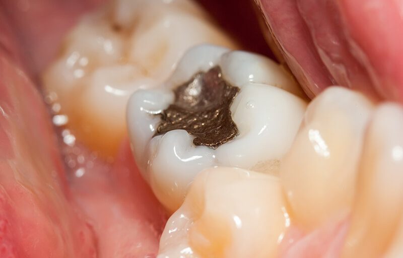 How to Take Care Of Your Dental Crown