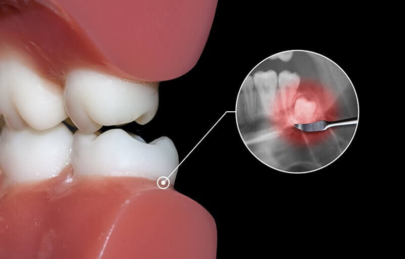 How Can I Control Gum Disease at Home?